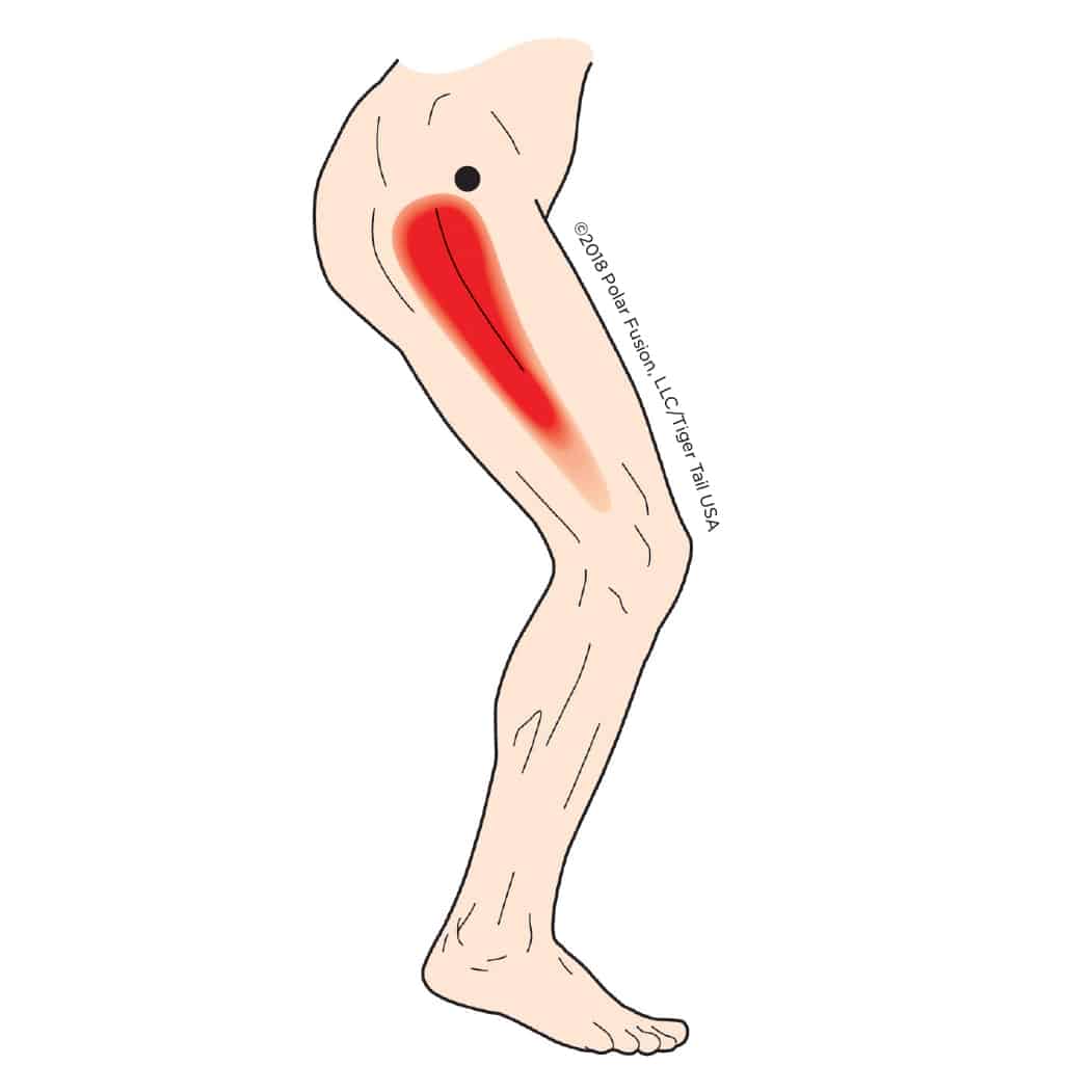 MuscleEducation_TensorFasciaeLatae_3-3 MuscleEducation_TensorFasciaeLatae_3-3